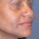 Juv&eacute;derm - Laugh Lines Before & After Patient #665