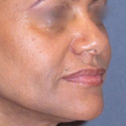 Juvéderm - Laugh Lines Before & After Patient #665