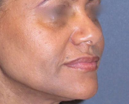 Juvéderm - Laugh Lines Before & After Patient #665