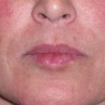 Juv&eacute;derm - Laugh Lines Before & After Patient #670