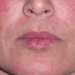 Juvéderm - Laugh Lines Before & After Patient #670