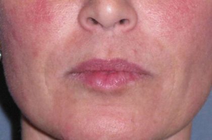 Juvéderm - Laugh Lines Before & After Patient #670