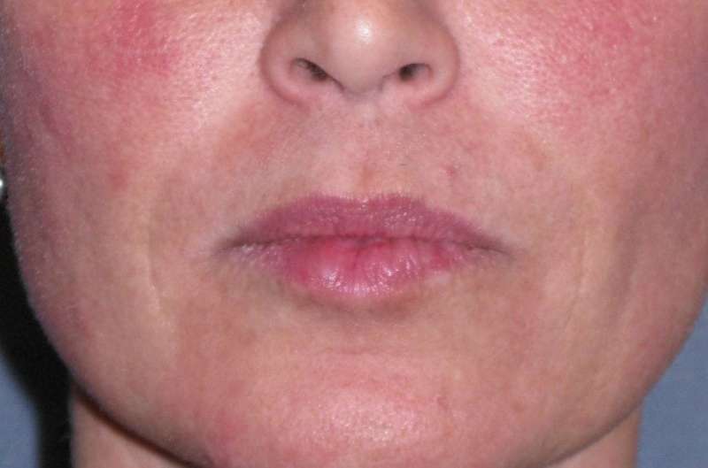 Juvéderm - Laugh Lines Before & After Patient #670
