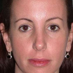 Fraxel Restore Before & After Patient #677