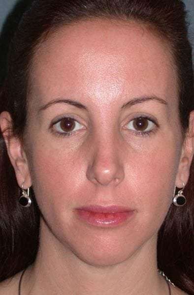 Fraxel Restore Before & After Patient #677