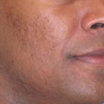 Fraxel Restore Acne Scarring Before & After Patient #682