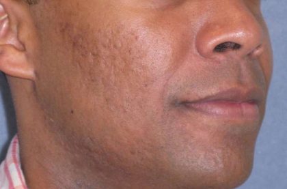 Fraxel Restore Acne Scarring Before & After Patient #682