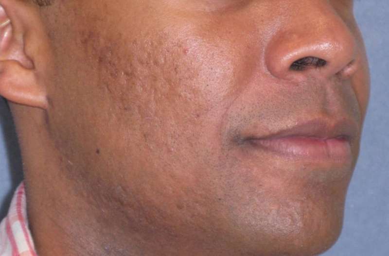 Fraxel Restore Acne Scarring Before & After Patient #682