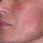 Juv&eacute;derm - Laugh Lines Before & After Patient #670