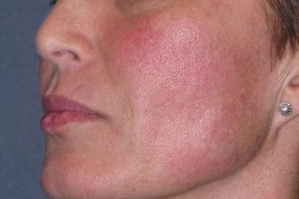 Juvéderm - Laugh Lines Before & After Patient #670