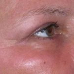 Eyelid Lift- Upper Before & After Patient #747