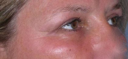 Eyelid Lift- Upper Before & After Patient #747
