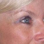 Eyelid Lift- Upper Before & After Patient #754
