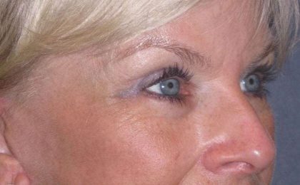 Eyelid Lift- Upper Before & After Patient #754
