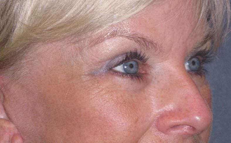 Eyelid Lift- Upper Before & After Patient #754