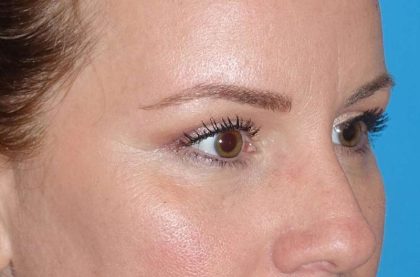 Eyelid Lift- Upper Before & After Patient #765