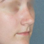 Rhinoplasty Before & After Patient #787