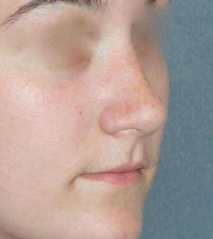 Rhinoplasty Before & After Patient #787