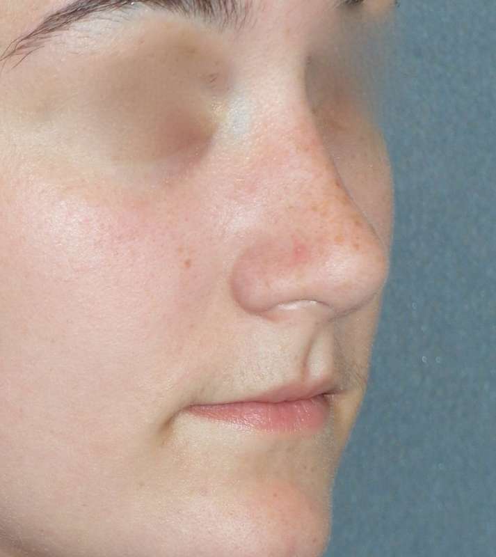 Rhinoplasty Before & After Patient #787