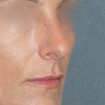 Rhinoplasty Before & After Patient #798