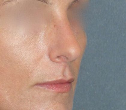 Rhinoplasty Before & After Patient #798