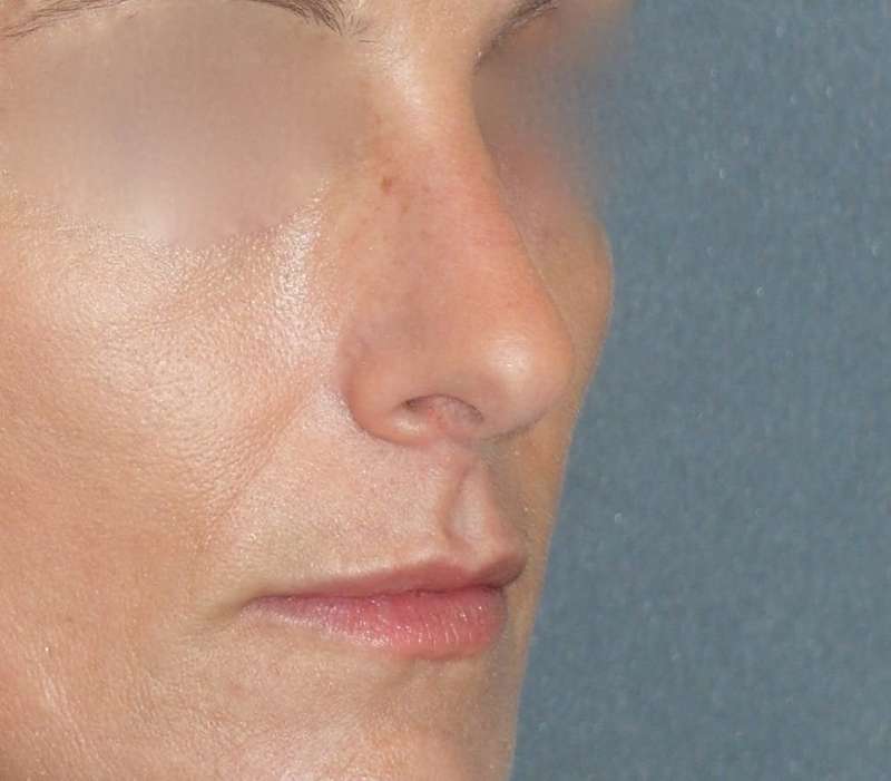 Rhinoplasty Before & After Patient #798