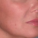 Juv&eacute;derm - Lips Before & After Patient #659