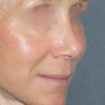 Rhinoplasty Before & After Patient #809