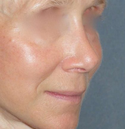 Rhinoplasty Before & After Patient #809