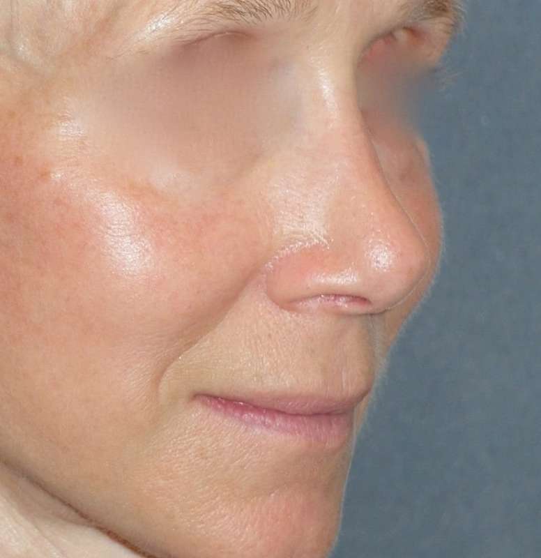 Rhinoplasty Before & After Patient #809