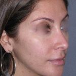 Rhinoplasty Before & After Patient #816