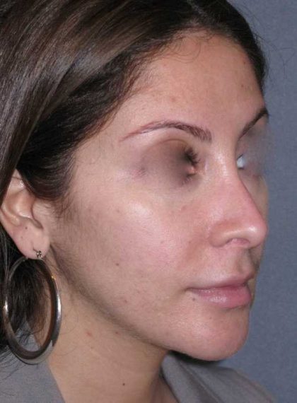 Rhinoplasty Before & After Patient #816