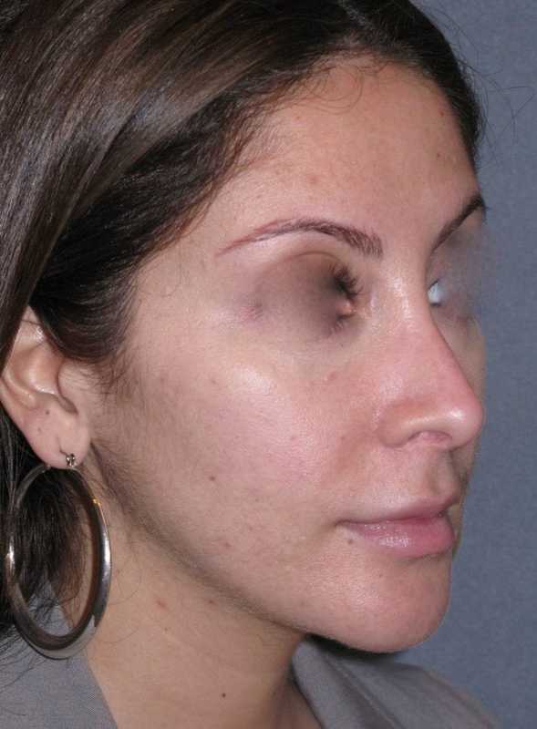 Rhinoplasty Before & After Patient #816