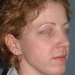Rhinoplasty Before & After Patient #823