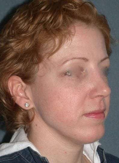 Rhinoplasty Before & After Patient #823