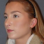 Rhinoplasty Before & After Patient #845