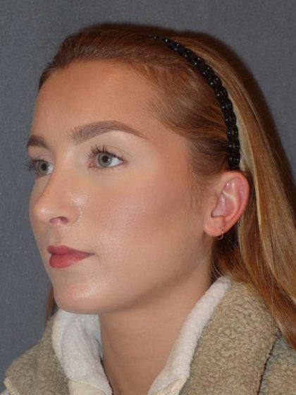 Rhinoplasty Before & After Patient #845