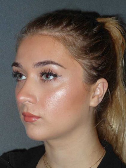 Rhinoplasty Before & After Patient #856