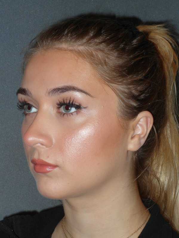 Rhinoplasty Before & After Patient #856