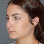 Rhinoplasty Before & After Patient #867