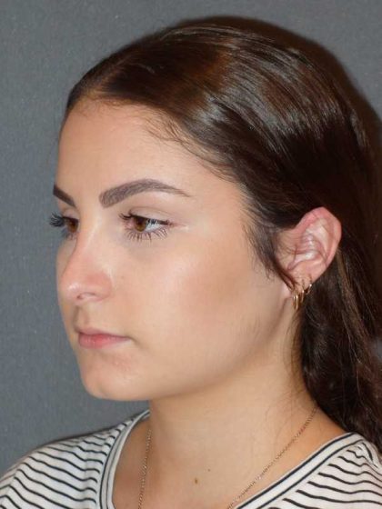 Rhinoplasty Before & After Patient #867