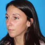 Rhinoplasty Before & After Patient #878
