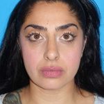 Rhinoplasty Before & After Patient #887