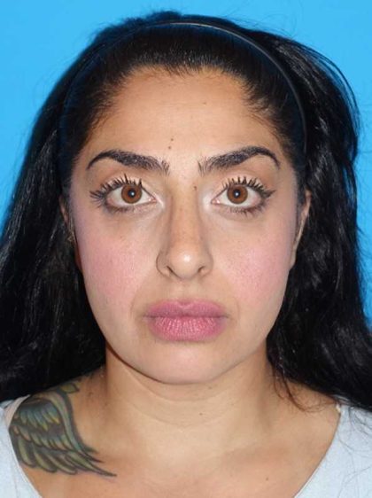 Rhinoplasty Before & After Patient #887