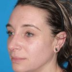 Rhinoplasty Before & After Patient #898