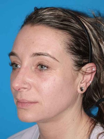 Rhinoplasty Before & After Patient #898