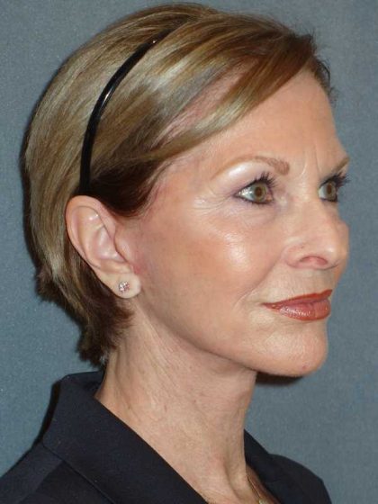 Deep Plane Lower Face & Neck Lift Before & After Patient #920