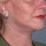 Deep Plane Lower Face & Neck Lift Before & After Patient #936