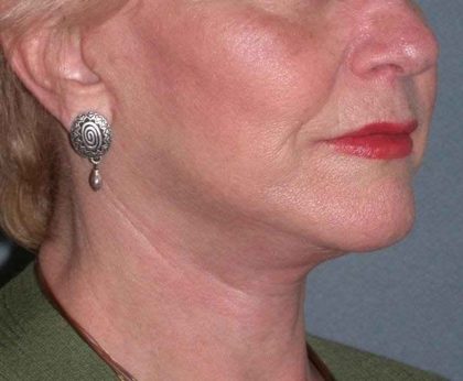 Deep Plane Lower Face & Neck Lift Before & After Patient #936
