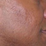Fraxel Restore Acne Scarring Before & After Patient #682